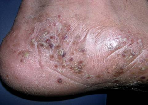 Đặc điểm và hình ảnh nhận biết bệnh tổ đỉa ở chân.