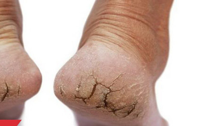 Bệnh chàm gót chân chia sẻ cách điều trị tốt nhất