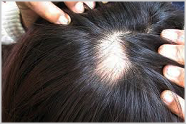 Rụng tóc từng vùng – những thông tin bệnh lý bạn có biết