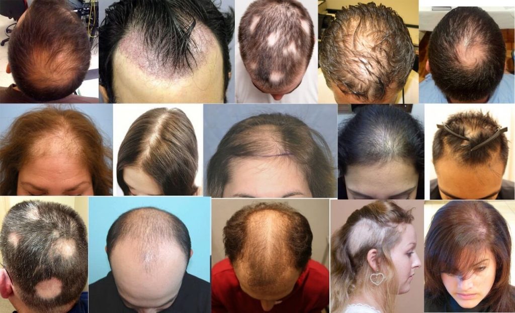 Rụng tóc từng mảng là gì? Nguyên nhân và cách điều trị.