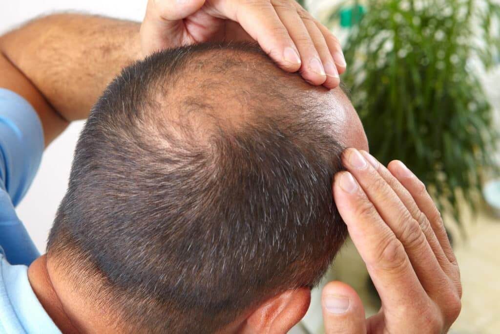 Rụng tóc ở nam giới nguyên nhân và cách khắc phục?
